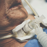Prise en charge du-de la patient-e trachéotomisé-e